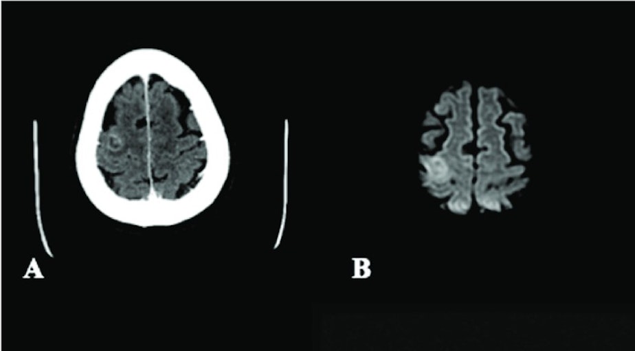 caption: Brain scans show swelling and excessive hemorrhaging in the patient's brain, caused by Balamuthia mandrillaris brain infection.