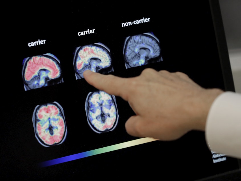 caption: Dr. William Burke reviews a PET brain scan at Banner Alzheimer's Institute in Phoenix in 2018. An experimental Alzheimer's drug from Biogen and Eisai is on the verge of a Food and Drug Administration decision.