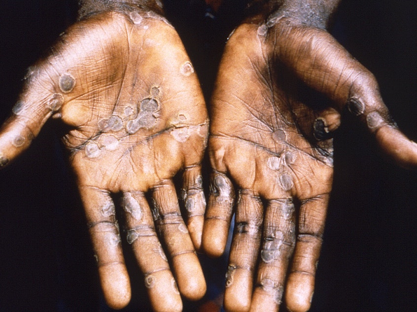 caption: The palms of a patient with mpox during a past outbreak in the Democratic Republic of Congo. The country is now seeing a dramatic spike in mpox.