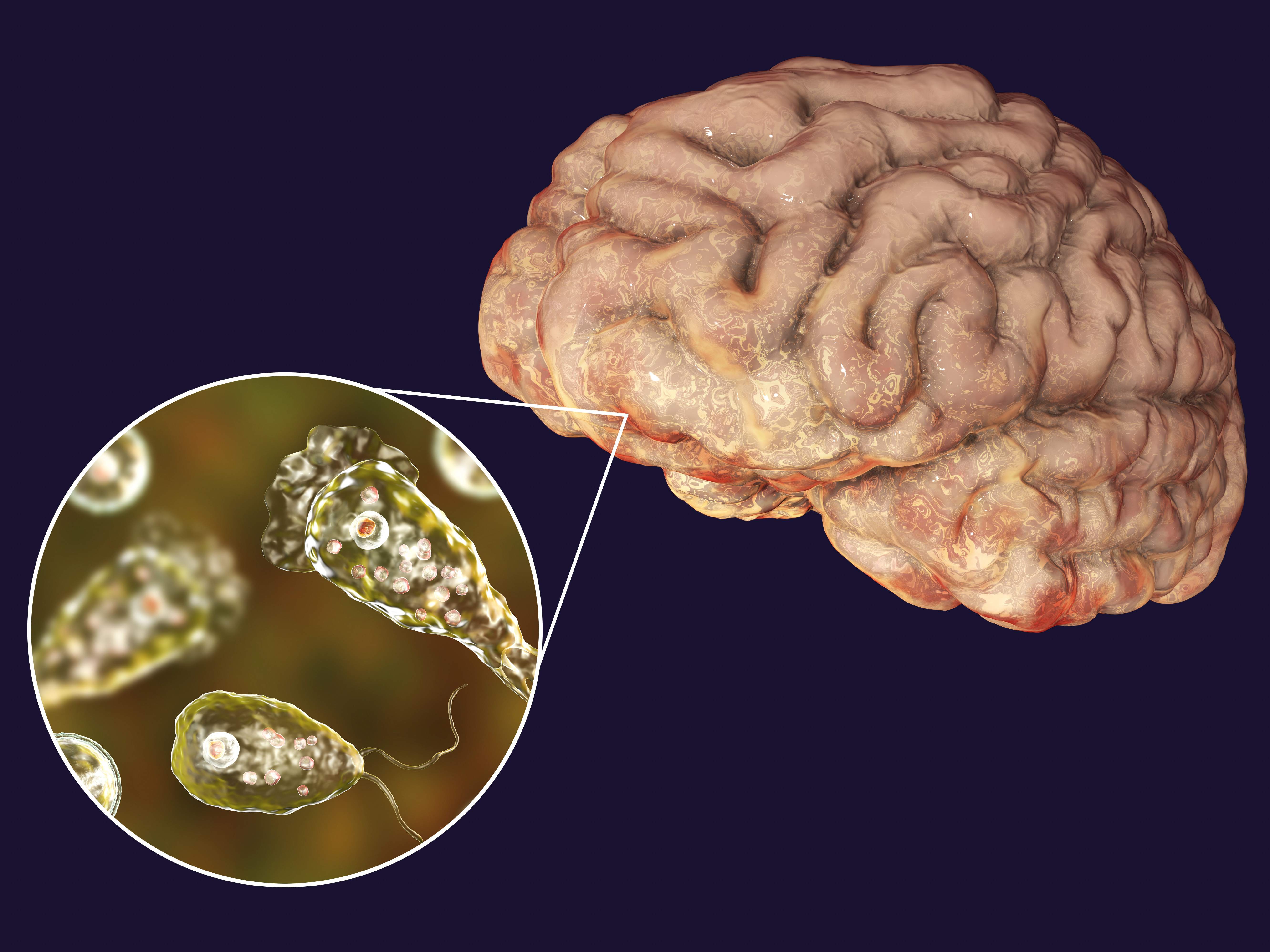 KUOW - 5 Things To Know About The Brain-eating Amoeba That Infected A ...