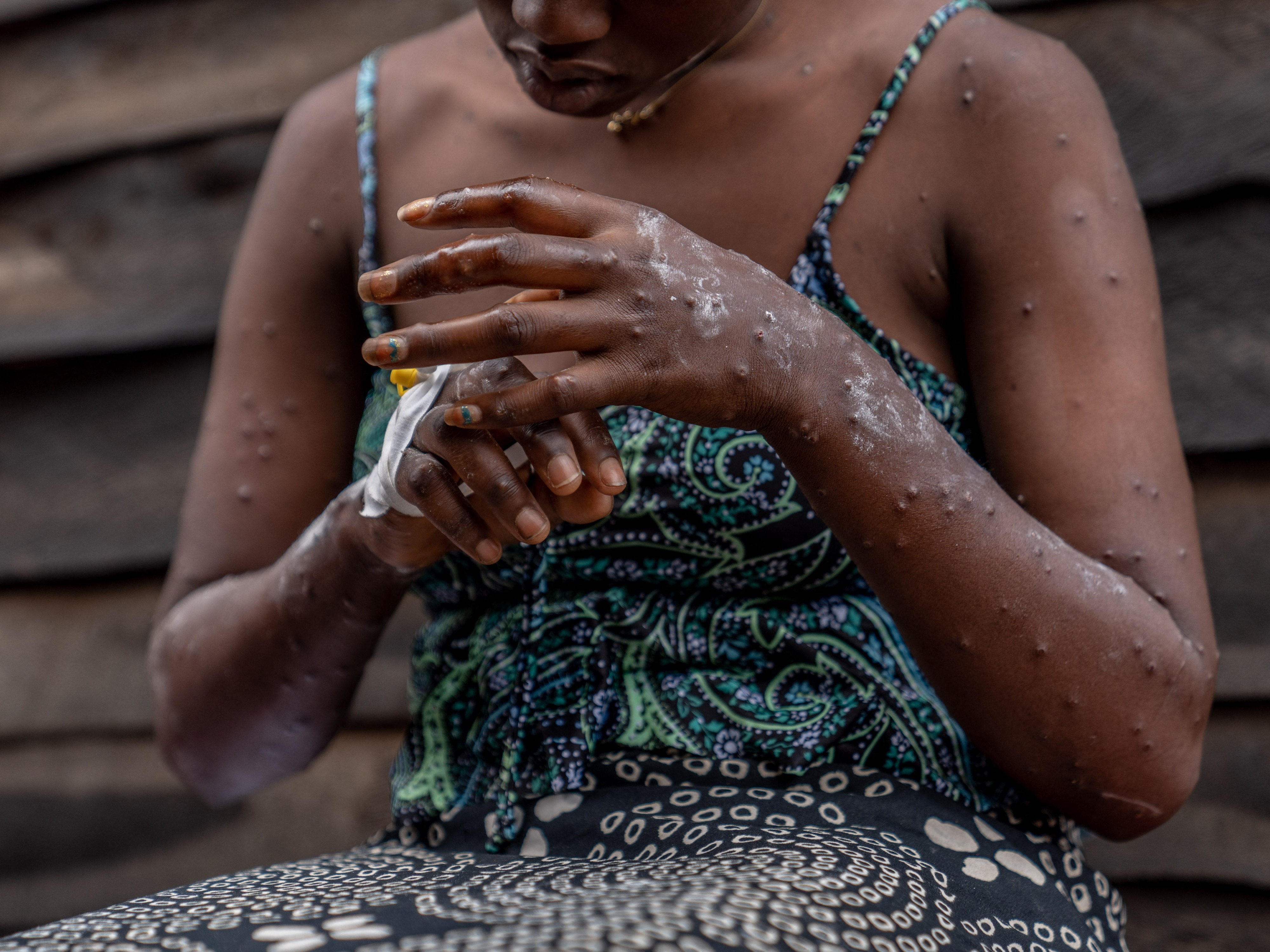 caption: A patient suffering from mpox sits on a bench at the Kavumu hospital in the eastern Democratic Republic of Congo — the global epicenter of the mpox outbreak,
