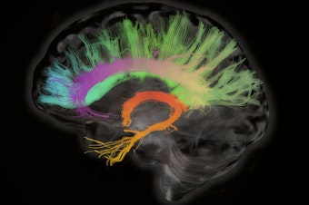 caption: A cross section of the human brain shows fiber tracts involved in aging.
