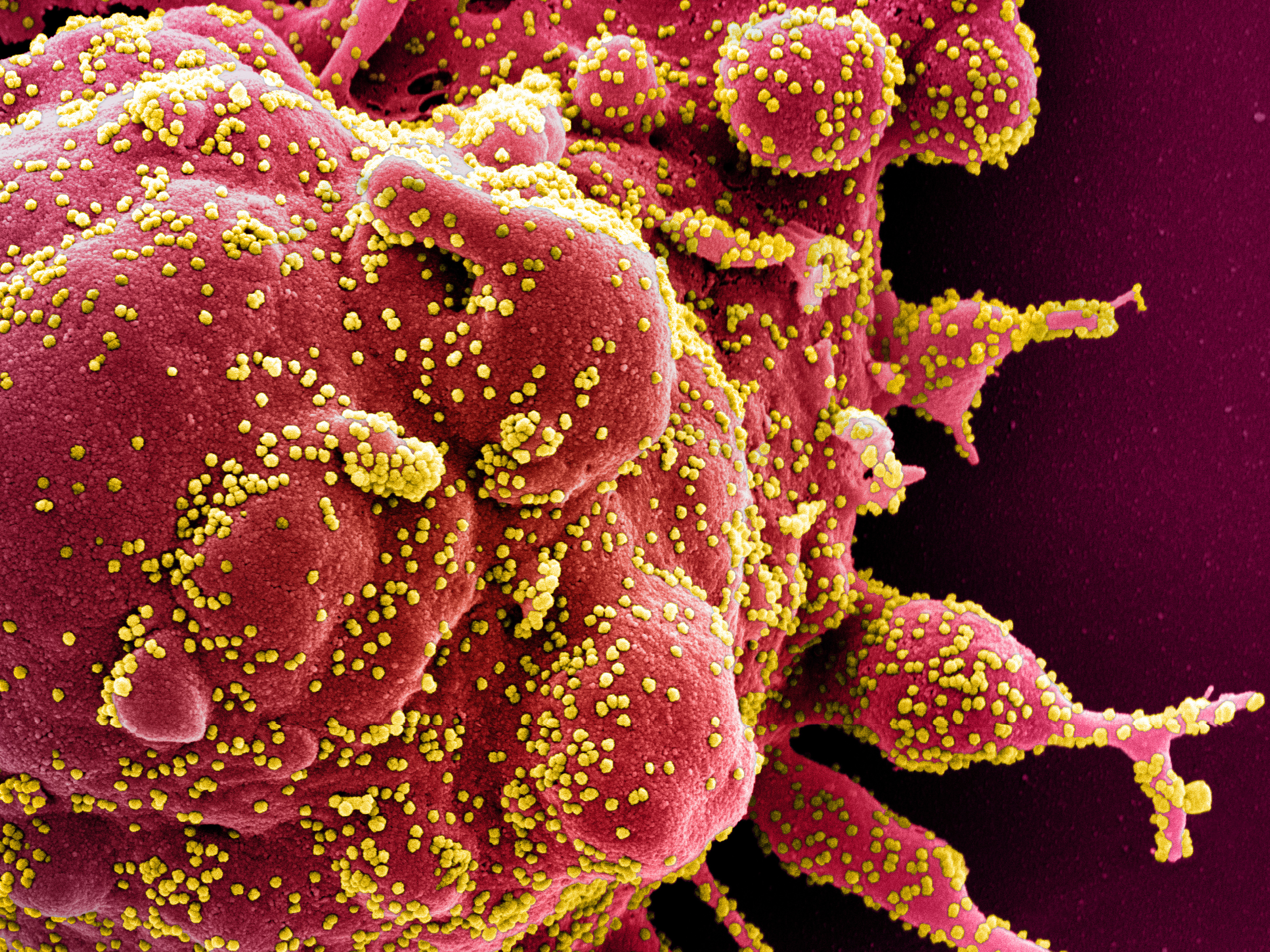 caption: A colorized electron micrograph image of a cell (red) infected with with SARS-CoV-2 virus particles (yellow), isolated from a patient sample.