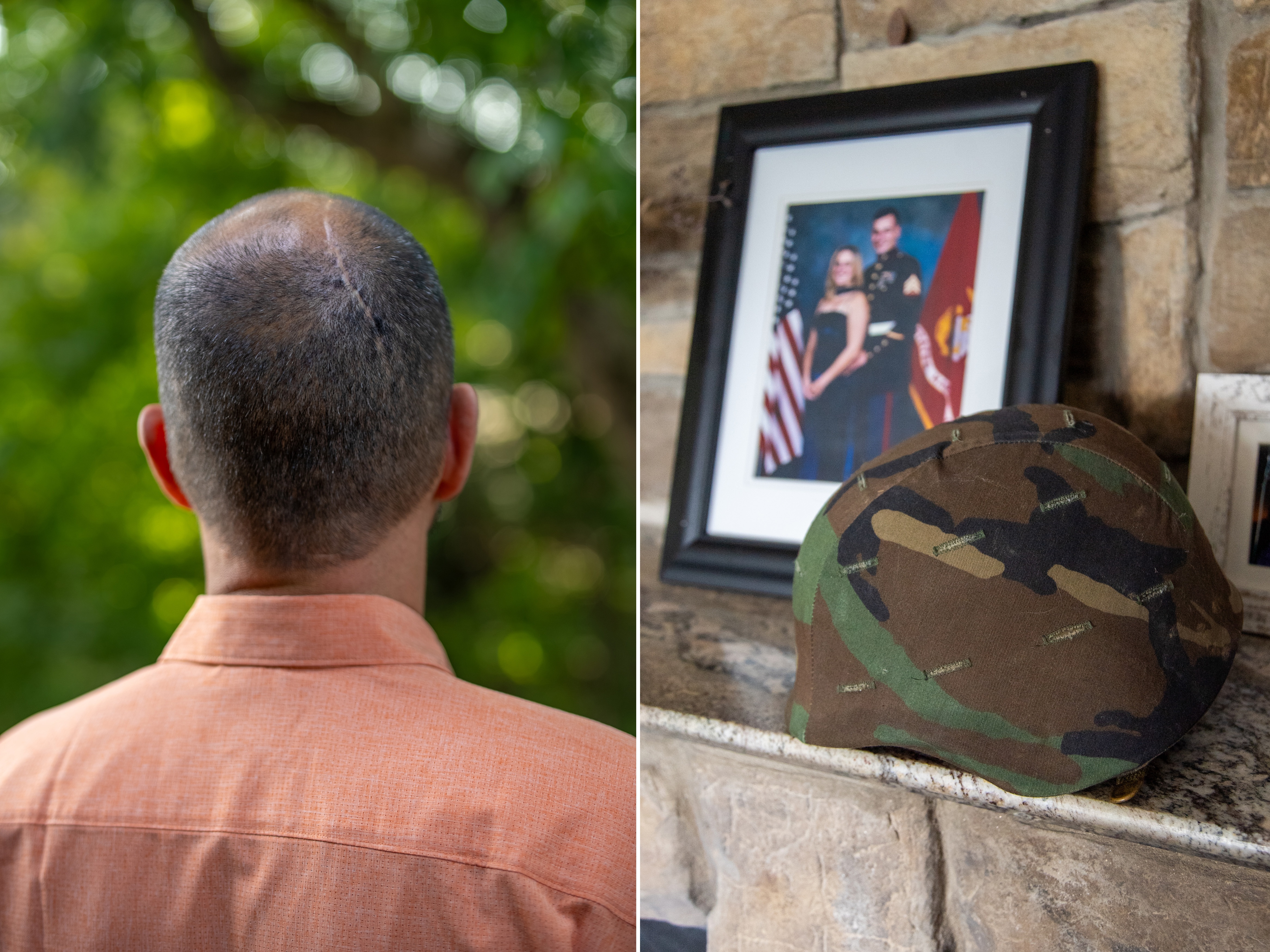 caption: During William Wilcox's service in the Marines, he fired heavy weapons, including shoulder-mounted missile launchers. The blast waves from those weapons may have led to an arteriovenous malformation (AVM) in his brain. As a result of the malformation and subsequent surgery, he now has epilepsy, memory problems, and other symptoms.