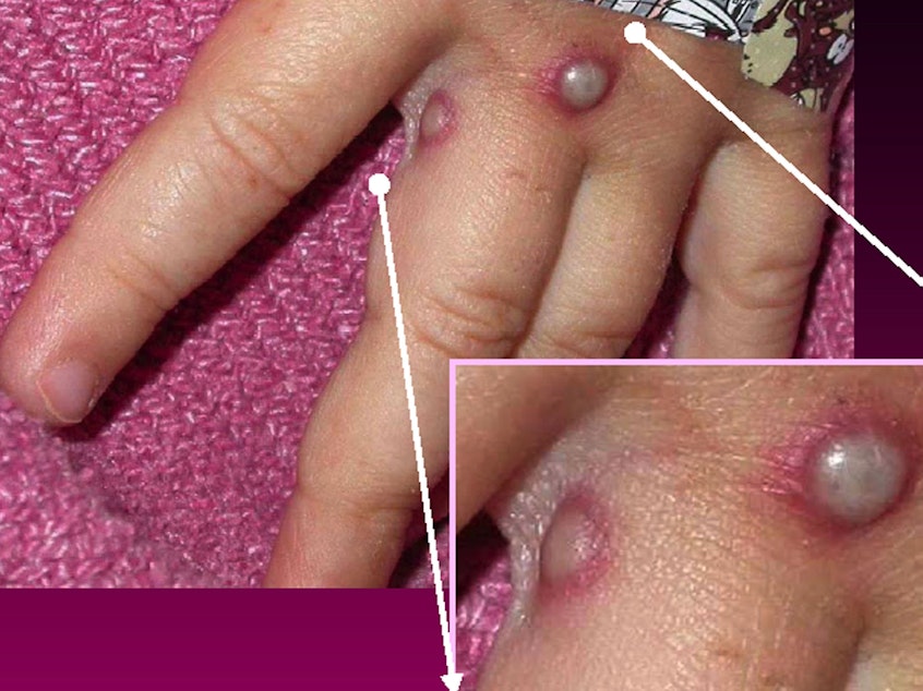 caption: Symptoms of the monkeypox virus are shown on a patient's hand, from a 2003 case in the U.S. In most instances, the disease causes fever and painful, pus-filled blisters. New cases in the United Kingdom, Spain and Portugal are spreading possibly through sexual contact, which had not previously been linked to monkeypox transmission.