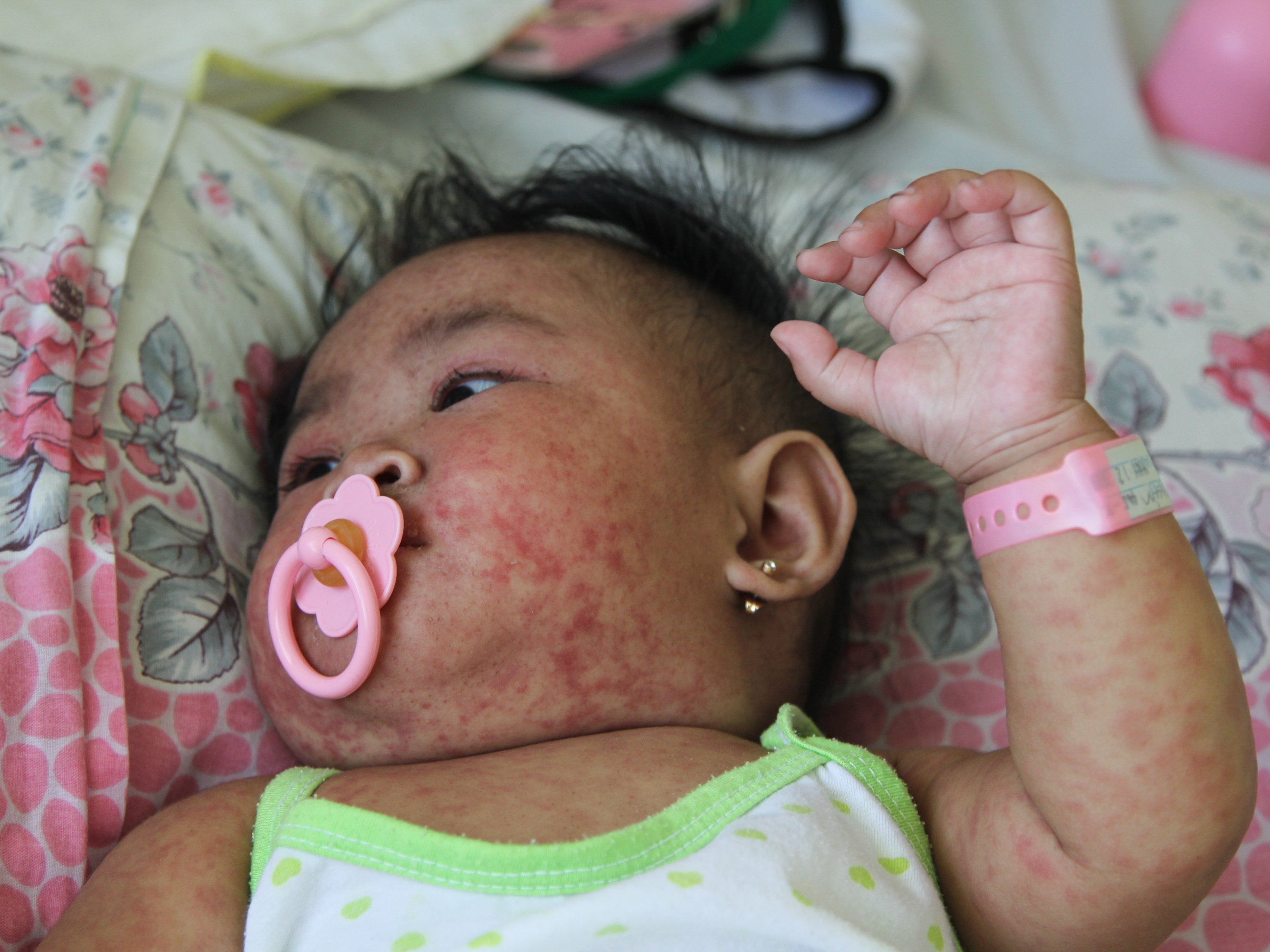 caption: A 6-month-old baby with measles at San Lazaro Hospital in Manila, Philippines. The country's measles outbreak has been partly driven by distrust of vaccines after a dengue vaccine scandal.