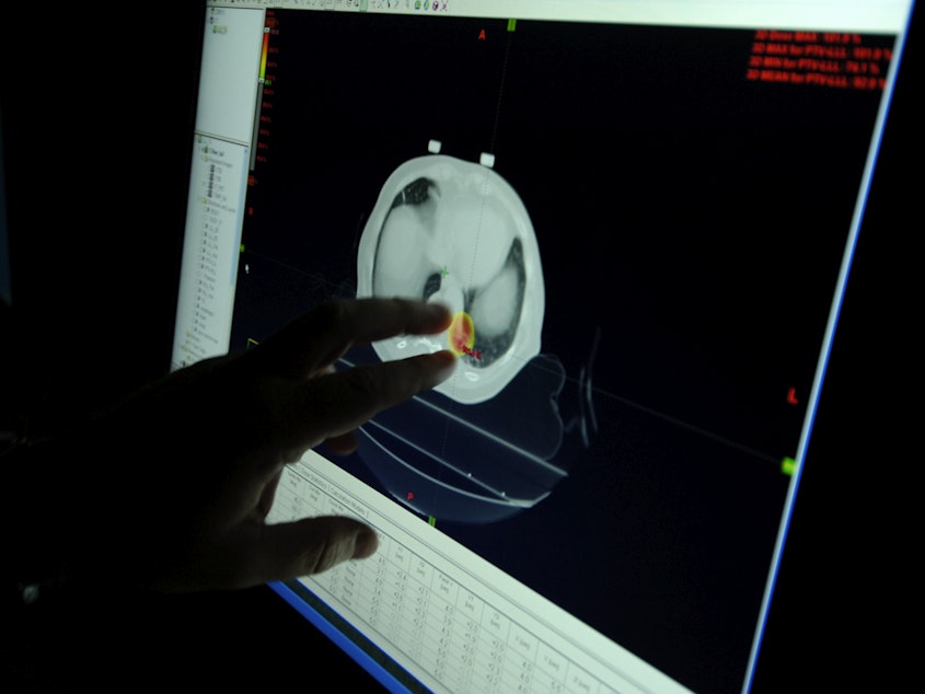 caption: A doctor assesses a radio surgery treatment plan for a patient with lung cancer, using a 4D CAT scan. Lung cancer survival rates have increased lately.
