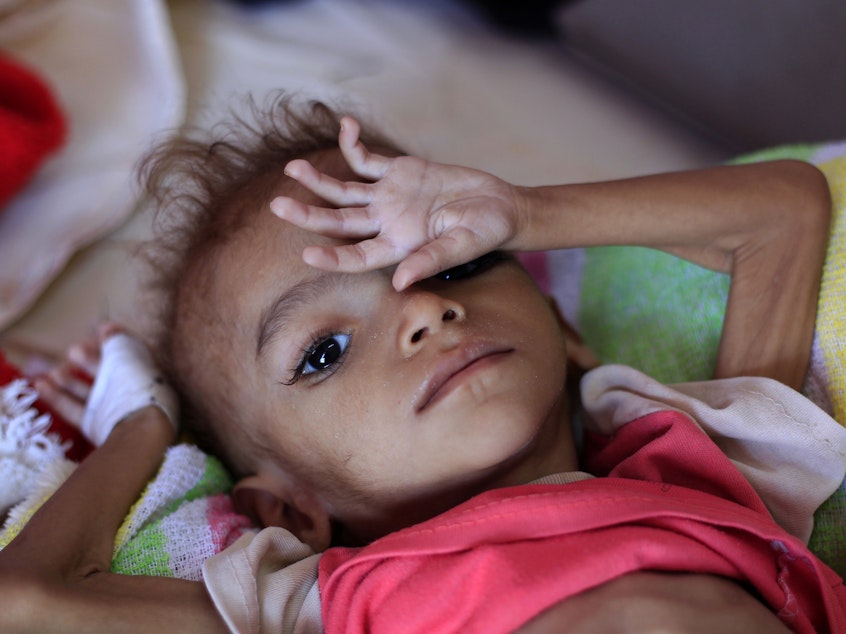 caption: A Yemeni child suffering from malnutrition lies on a bed at a treatment center in a hospital in the capital, Sanaa.