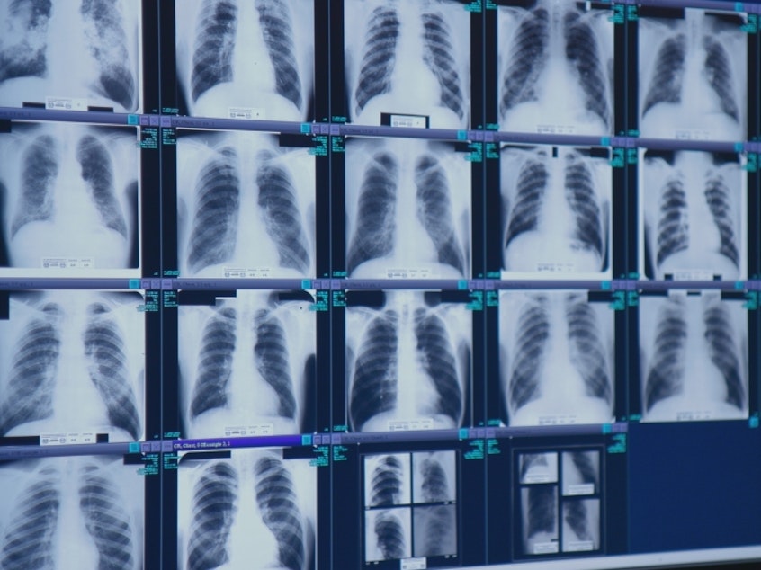 caption: The safety rules being announced and finalized today will hold mines to the same standard for silica dust exposure as other employers. These x-rays show black lung disease.