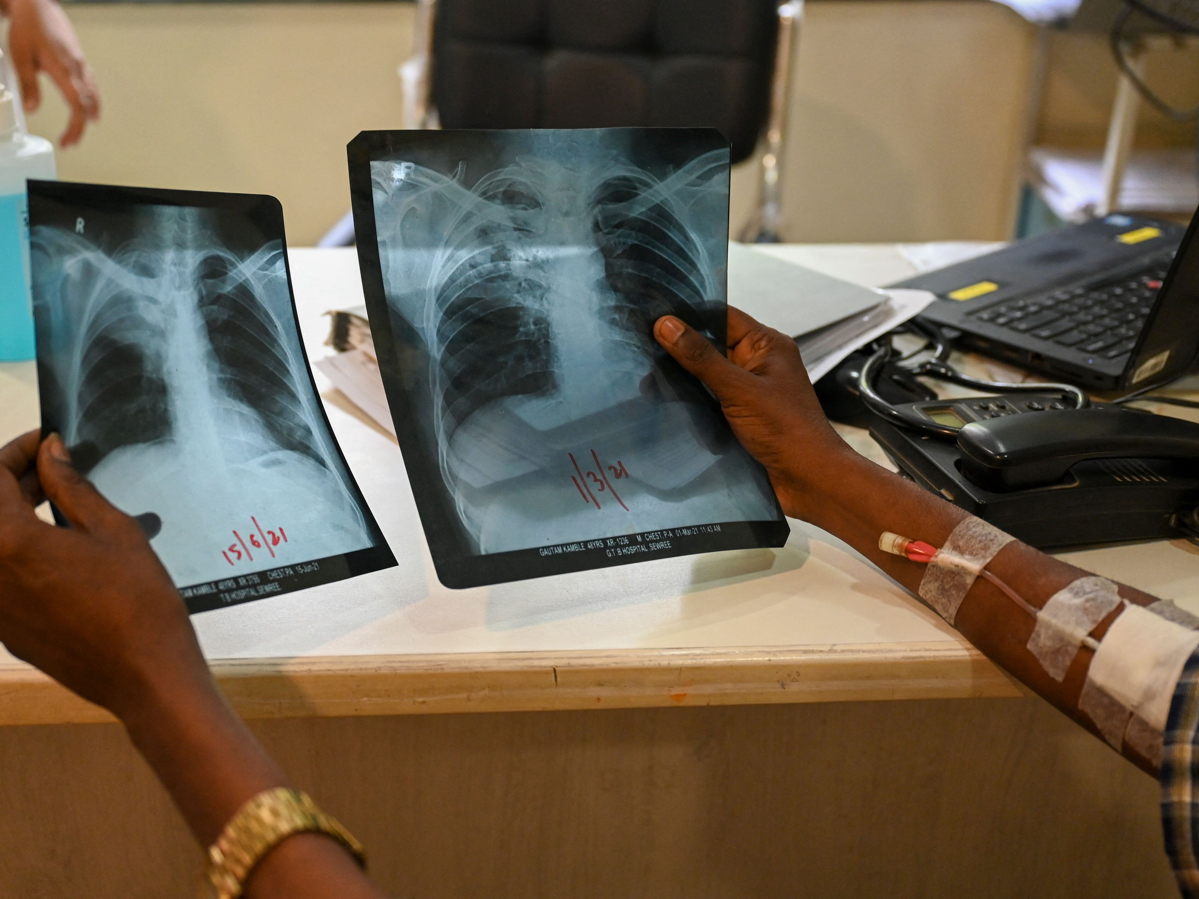 caption: A patient who was diagnosed with tuberculosis holds his chest x-rays while consulting with a doctor at the Médecins Sans Frontières clinic in Mumbai, which treats people with drug-resistant tuberculosis.