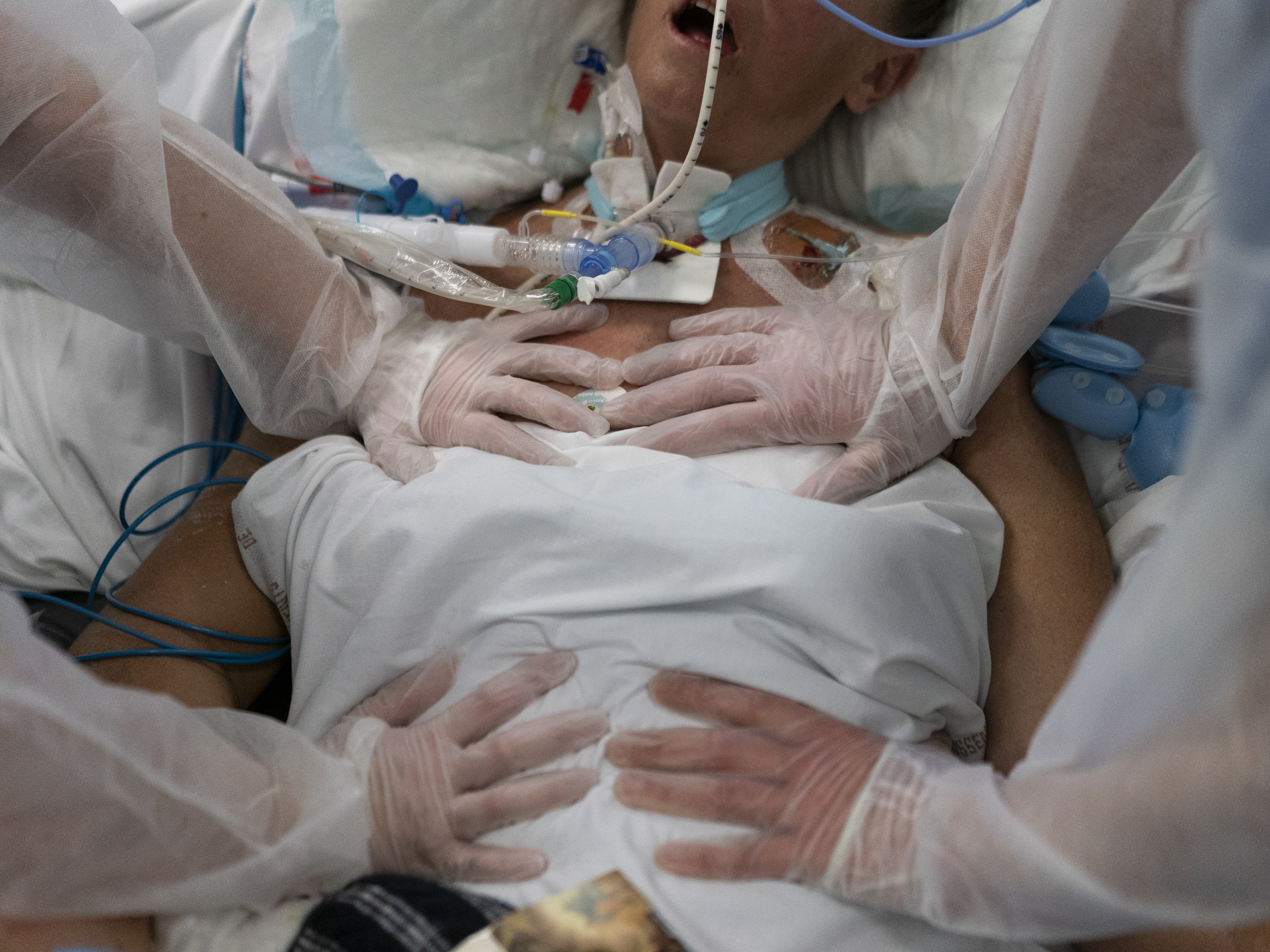 caption: Nurses perform timed breathing exercises on a COVID-19 patient on a ventilator in the COVID-19 intensive care unit at the la Timone hospital in Marseille, southern France on Dec. 31, 2021.