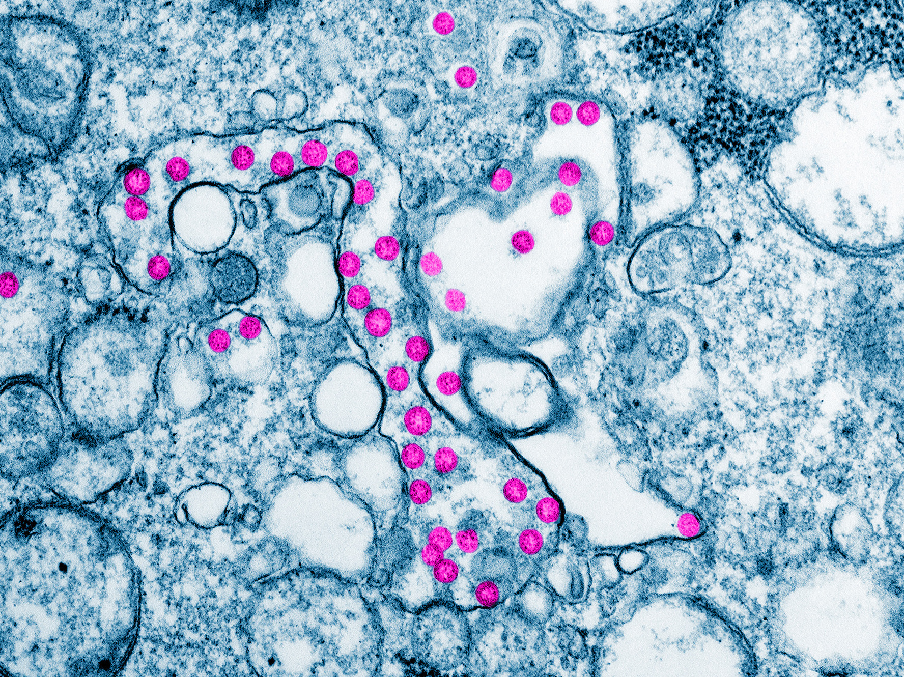 caption: Viral particles are colorized purple in this color-enhanced transmission electron micrograph, from a COVID-19 patient in the U.S. Computer modeling can help epidemiologists predict how and where the illness will next move.