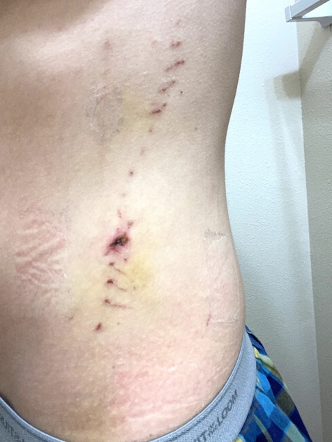 caption: Joaquin Uribe, 19, sustained multiple injuries, including a puncture wound in his abdomen, bruises, and scrapes amid a confrontation with a Seattle police officer on Sunday, May 31, during a demonstration against racism and police violence.