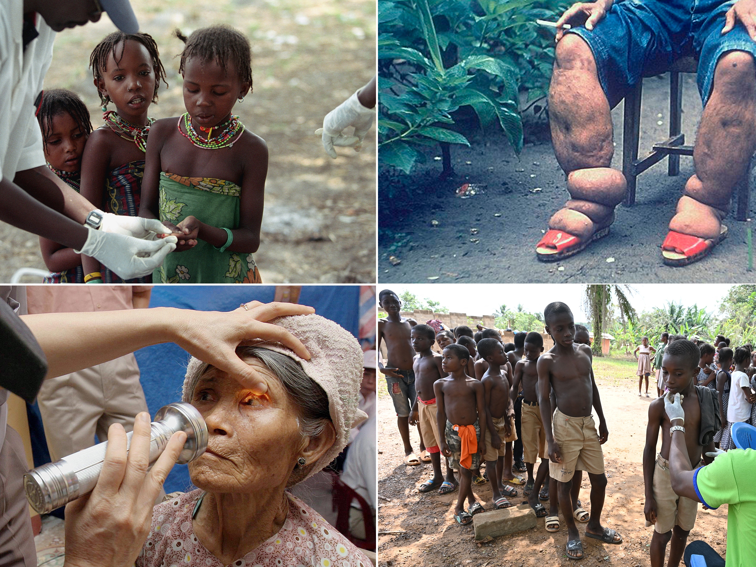 caption: Clockwise from upper left: Nomads from the Peul tribe give blood samples to be tested for sleeping sickness. In 2024, Chad got rid of one form of the disease. Brazil and Timor Leste eliminated lymphatic filariasis, the disfiguring parasite that causes a condition known as elephantiasis. A doctor sees children during a leprosy screening campaign; Jordan eliminated the disease this year. An elderly farmer woman receives an eye exam for trachoma in Vietnam — which along with India and Pakistan — eradicated the