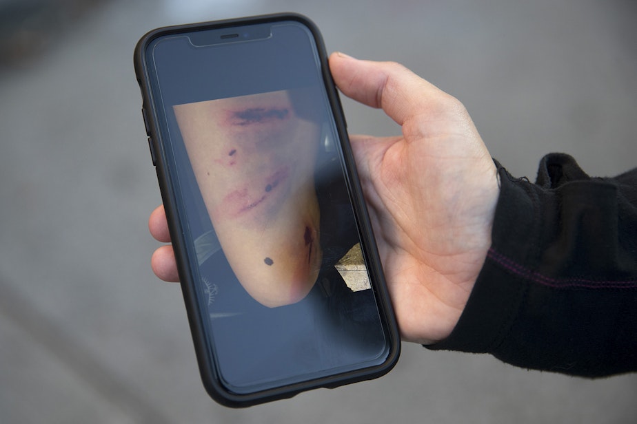 caption: A person protesting for racial justice and against police brutality displays a picture of injuries that were sustained after they were hit directly in the leg with a flash bang grenade thrown by Seattle Police officers at the intersection of 11th Avenue and East Pine Street following the Youth Liberation Front march in solidarity with Portland, on Saturday, July 25, 2020, in Seattle.