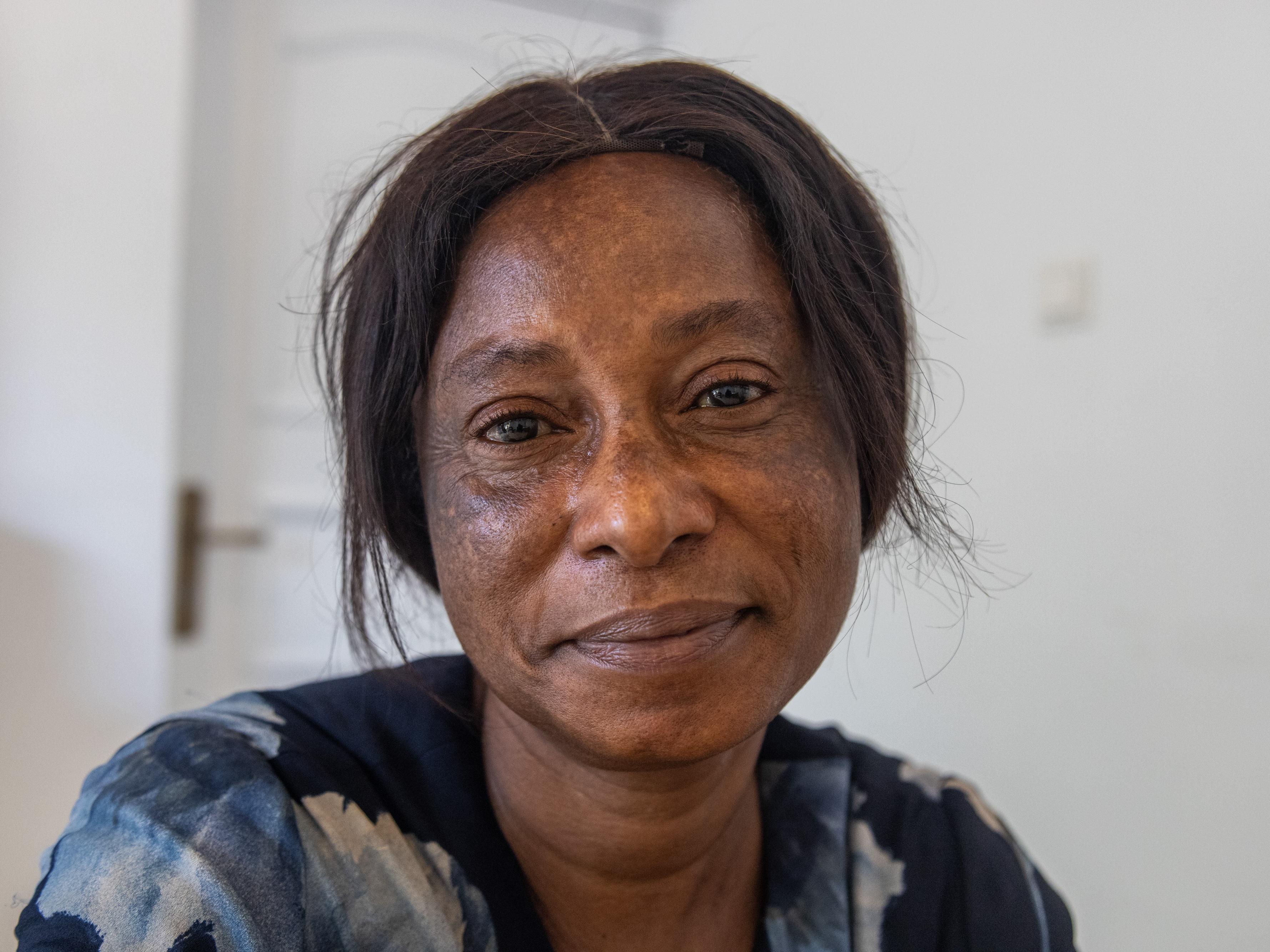 caption: Susan Anderson began using skin lightening creams at age 12. Now 52, she has stopped using the products but her skin shows the damage they caused.