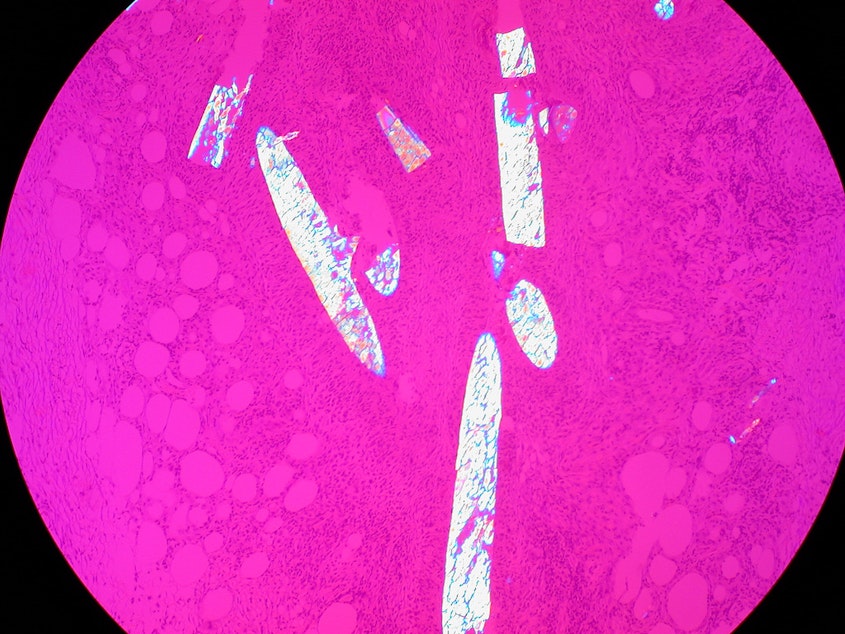 caption: Radiographic marker in lumpectomy specimen