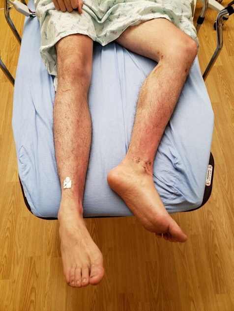 caption: Andrew Devers' legs after he went missing for nine days in the woods near North Bend, Washington, about 40 minutes away from where he lives. Devers, 25, said that his wounds stopped healing as well the longer he went without enough food.