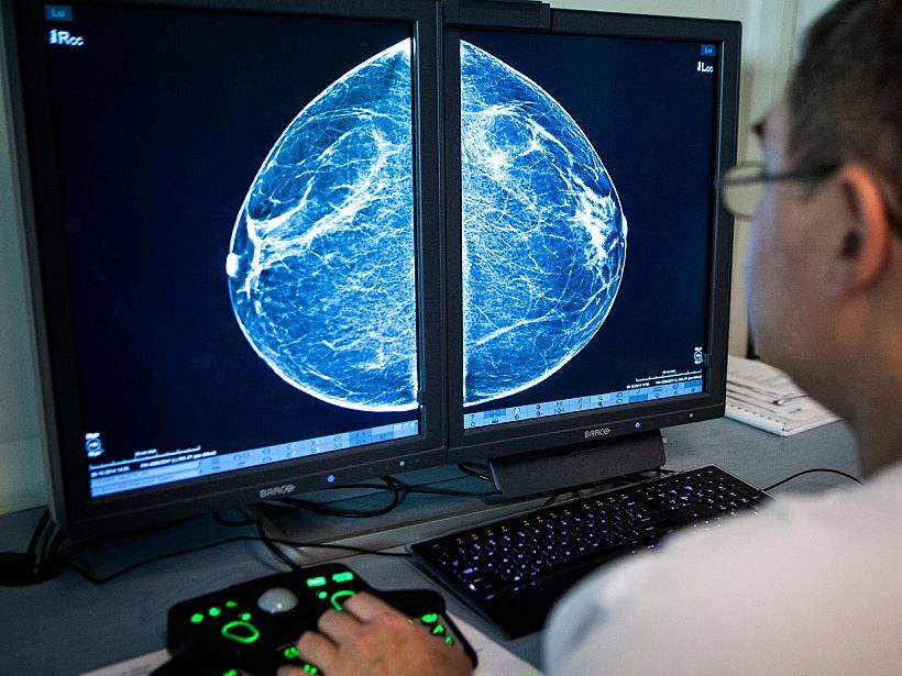 caption: When radiologists review mammograms for signs of breast cancer, they can also see arterial calcification in the breast, which is linked with cardiovascular disease risk.