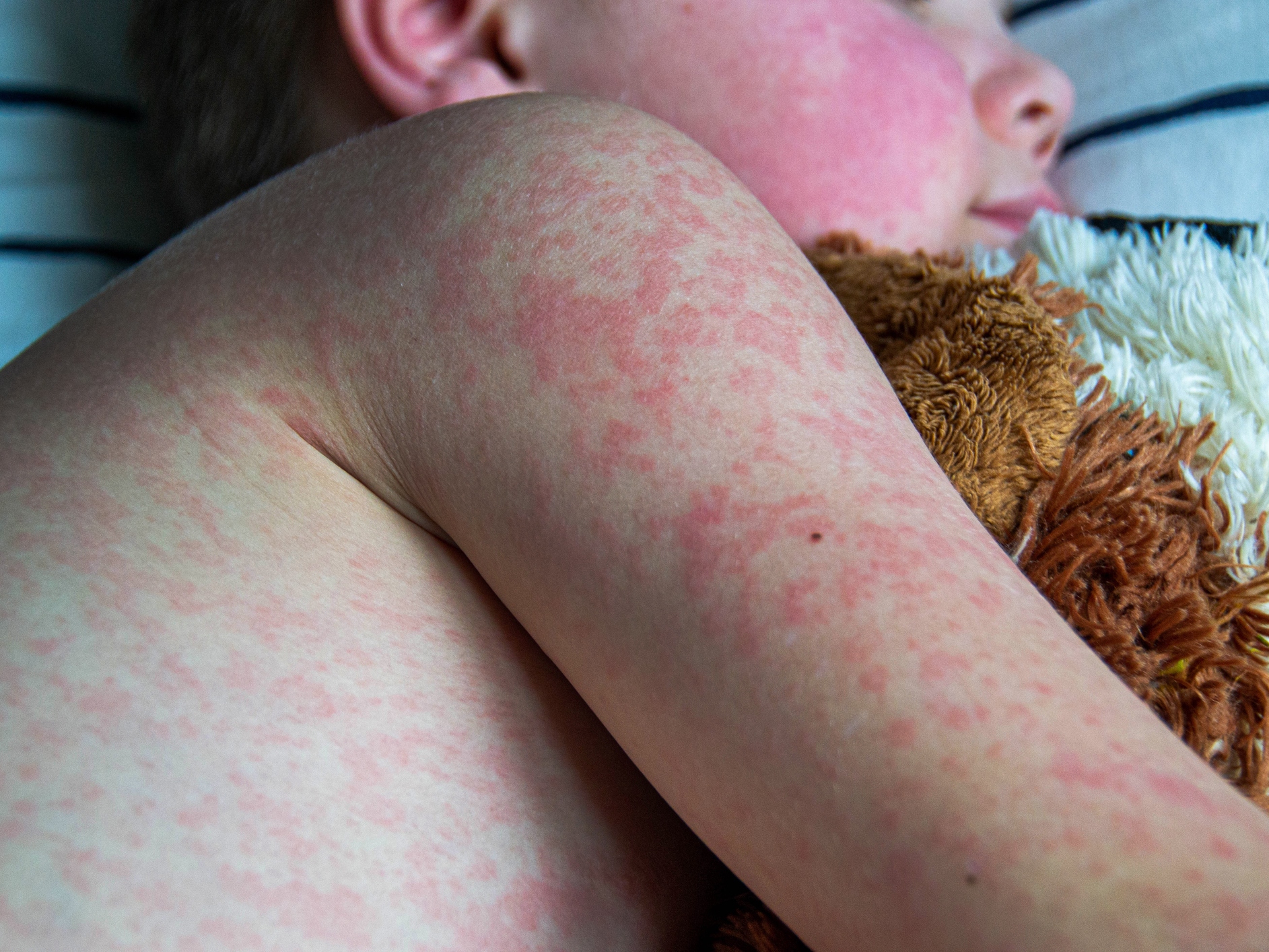 caption: Measles kills thousands of children across the globe every year.