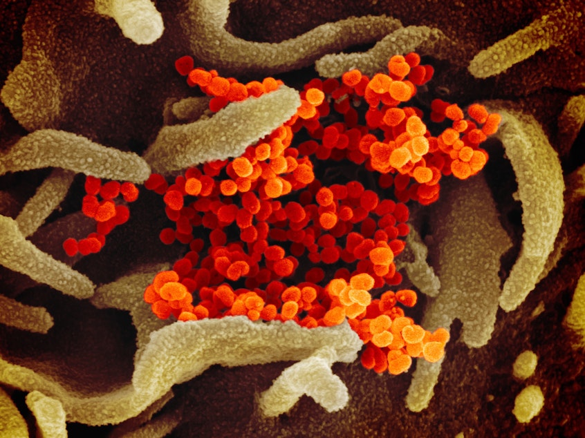 caption: In this image from a scanning electron microscope, the new coronavirus is in orange.