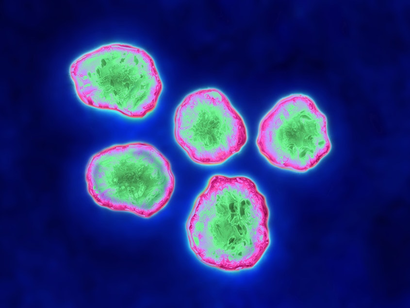 caption: New research illuminates how the measles virus may suppress the immune system after an infection.