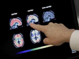 caption: Dr. William Burke goes over a PET brain scan in 2018 at Banner Alzheimer's Institute in Phoenix. The drug company Biogen has received federal approval for a medicine to treat early Alzheimer's disease.