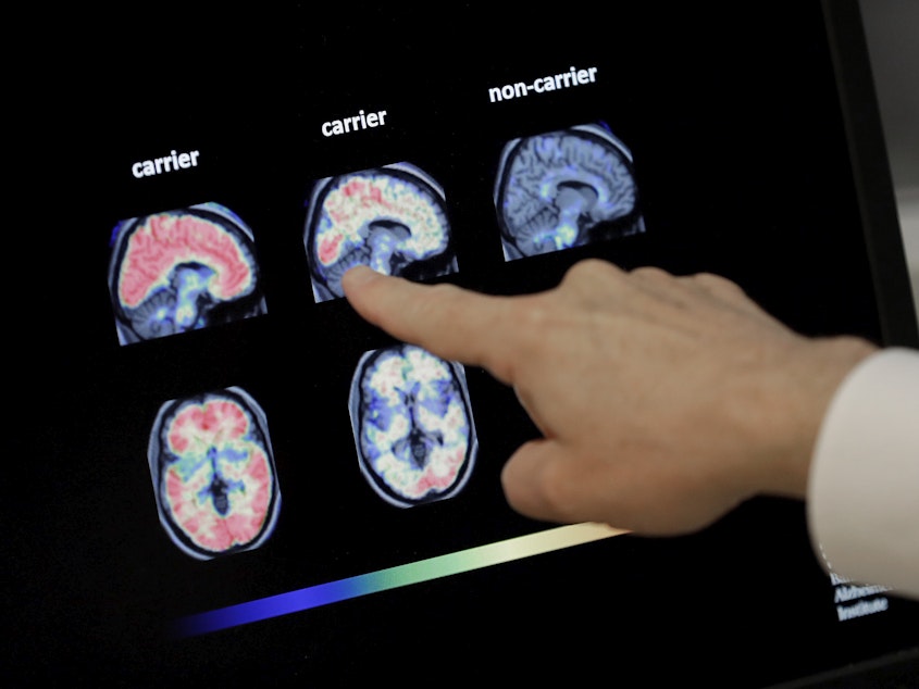 caption: Dr. William Burke goes over a PET brain scan in 2018 at Banner Alzheimer's Institute in Phoenix. The drug company Biogen has received federal approval for a medicine to treat early Alzheimer's disease.