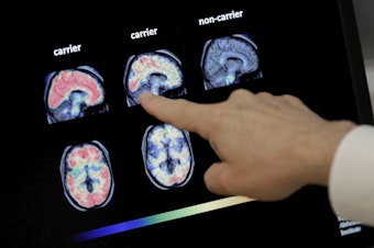 caption: Dr. William Burke goes over a PET brain scan in 2018 at Banner Alzheimer's Institute in Phoenix. The drug company Biogen has received federal approval for a medicine to treat early Alzheimer's disease.