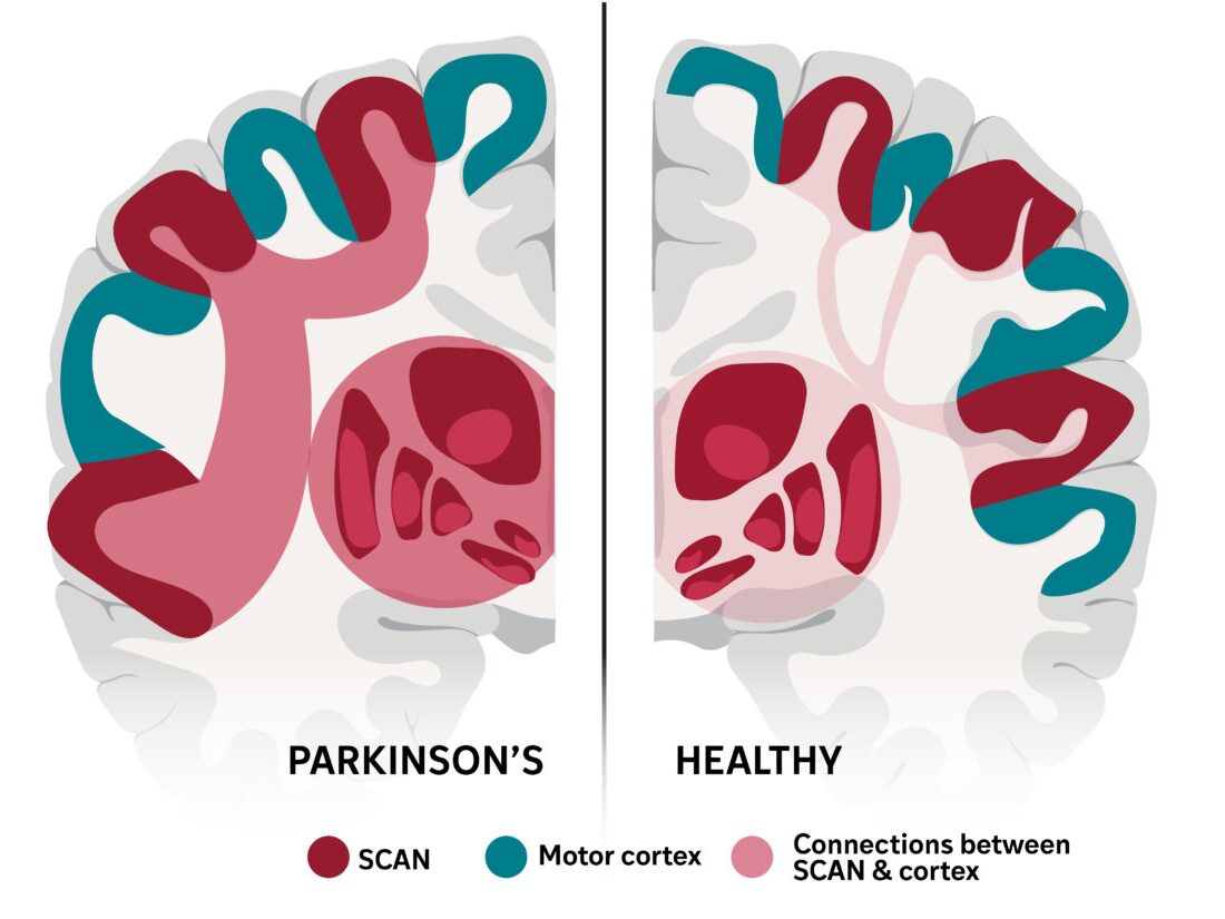 caption: The SCAN network, which links movement and thinking, appears to be a key brain area affected in Parkinson's disease.<br>