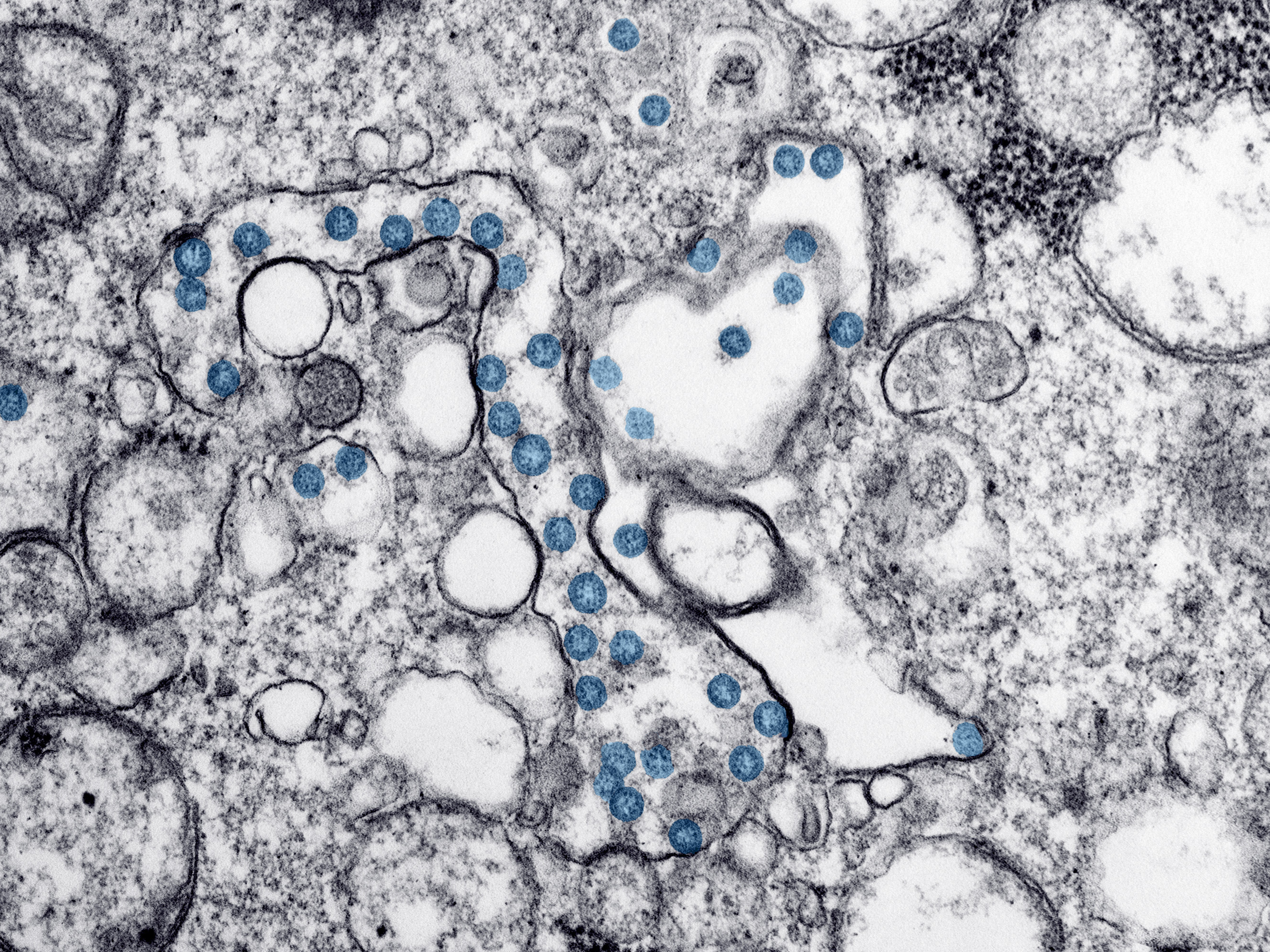 caption: This 2020 electron microscope image made available by the U.S. Centers for Disease Control and Prevention shows the spherical particles of the new coronavirus, colorized blue. New York is planning a major effort to test the population for antibodies for the coronavirus as a key to deciding whether to reopen the economy.