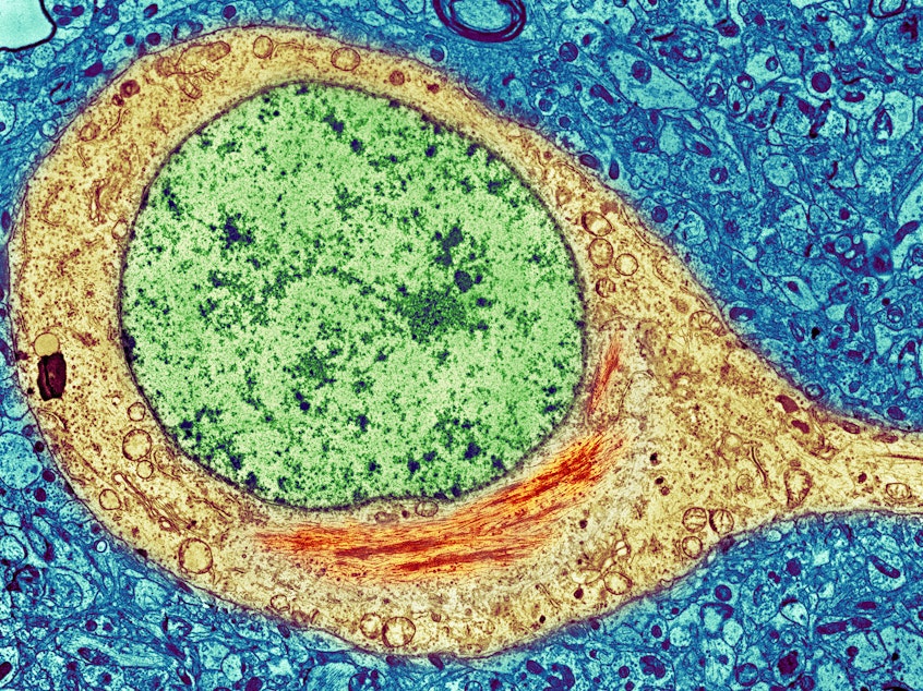 caption: A colorized image of a brain cell from an Alzheimer's patient shows a neurofibrillary tangle (red) inside the cytoplasm (yellow) of the cell. The tangles consist primarily of a protein called tau.