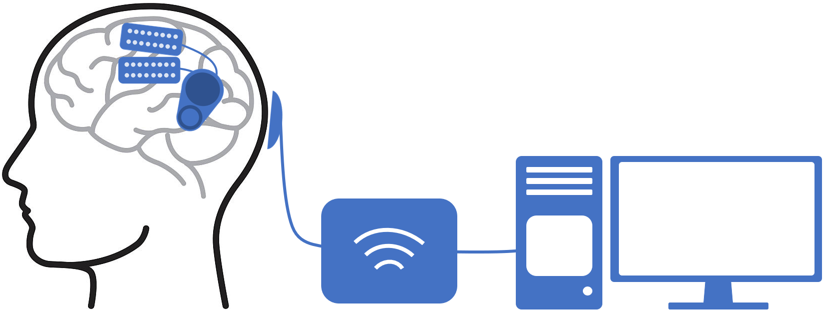 caption: The Implantable Brain Interchange system being tested by researchers at UW Medicine. The system uses cortical electrodes on the brain and a unit for power and communication implanted on the skull which communicates with an external computer.