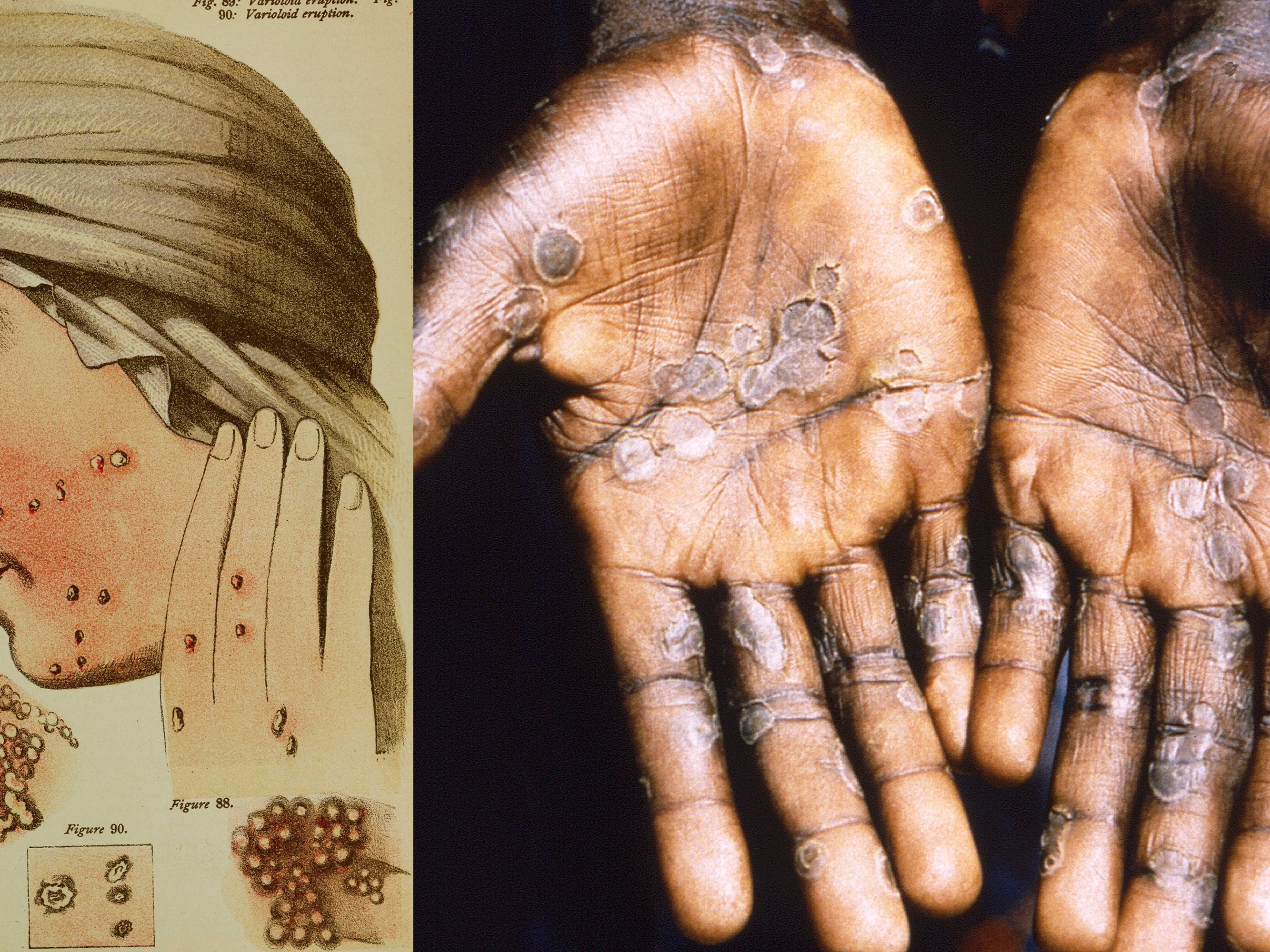 caption: Smallpox and mpox are related diseases — and the eradication of the former inadvertently creating an opening for the latter. At left: An illustration from 1884 depicts smallpox pustules on the face and hand of a woman. At right: A 1997 photograph shows the palms of a woman who contracted mpox during an outbreak in the Democratic Republic of Congo.<br>