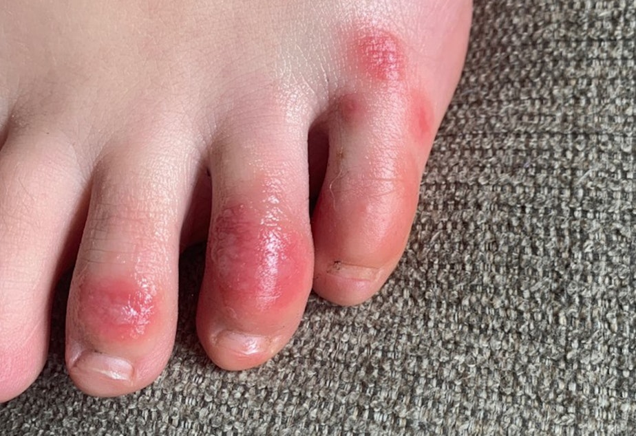 caption: This April 3, 2020, photo provided by Northwestern University shows discoloration on a teenage patient's toes at the onset of the condition informally called "Covid toes." The red, sore and sometimes itchy swellings on toes look like chilblains, something doctors normally see on the feet and hands of people who've spent a long time outdoors in the cold.