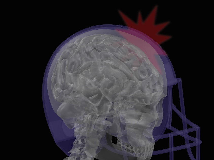 caption: Researchers are studying athletes and military personnel to learn more about how a concussion can affect the brain's ability to understand sound.