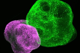 caption: This image shows a brain "assembloid" consisting of two connected brain "organoids." Scientists studying these structures have restored impaired brain cells in Timothy syndrome patients.
