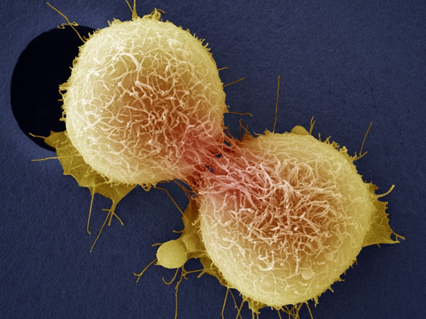caption: Cancer of the cervix is one of the most common cancers affecting women and can be fatal. Here, cervical cancer cells are dividing, as seen through a colored scanning electron micrograph.