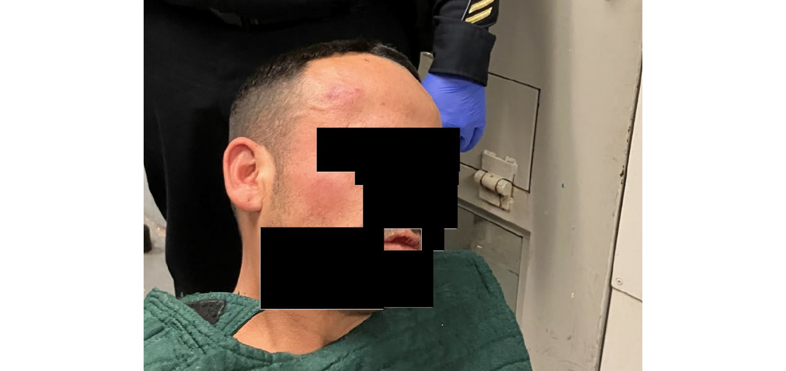 caption: A King County Ombuds report includes photos of a man's injuries after he was punched by corrections officers on Nov. 10, 2024. The photo released to KUOW included blacked out portions to protect the man's identity.