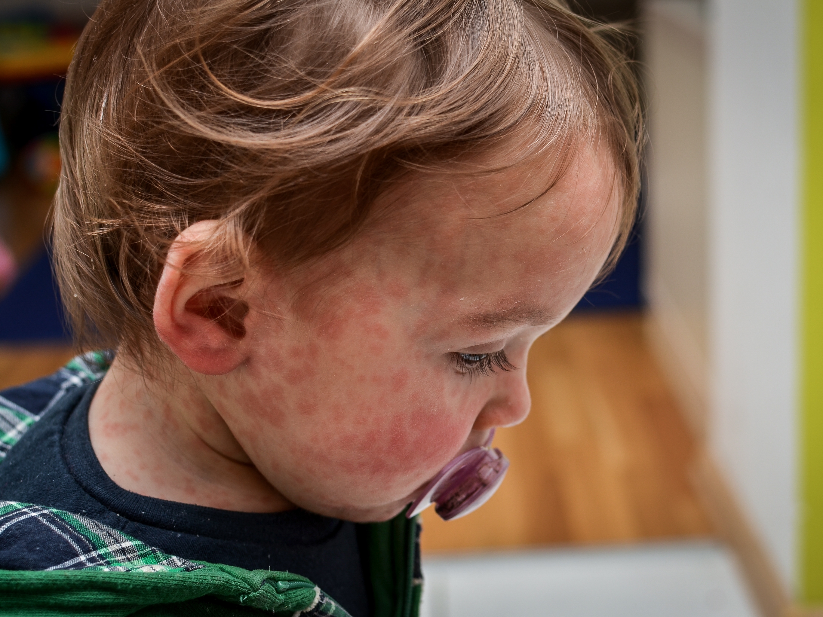 caption: Most kids recover from measles. But the virus can be deadly and can erase the immune system's memory.