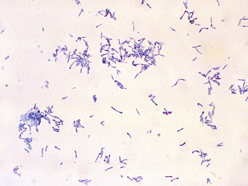 caption: The potentially fatal disease diphtheria is caused by bacteria — the club-shaped, Gram-positive, Corynebacterium diphtheriae bacilli shown in this microscope photo.