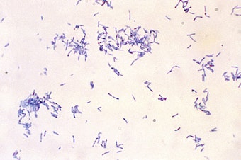 caption: The potentially fatal disease diphtheria is caused by bacteria — the club-shaped, Gram-positive, Corynebacterium diphtheriae bacilli shown in this microscope photo.